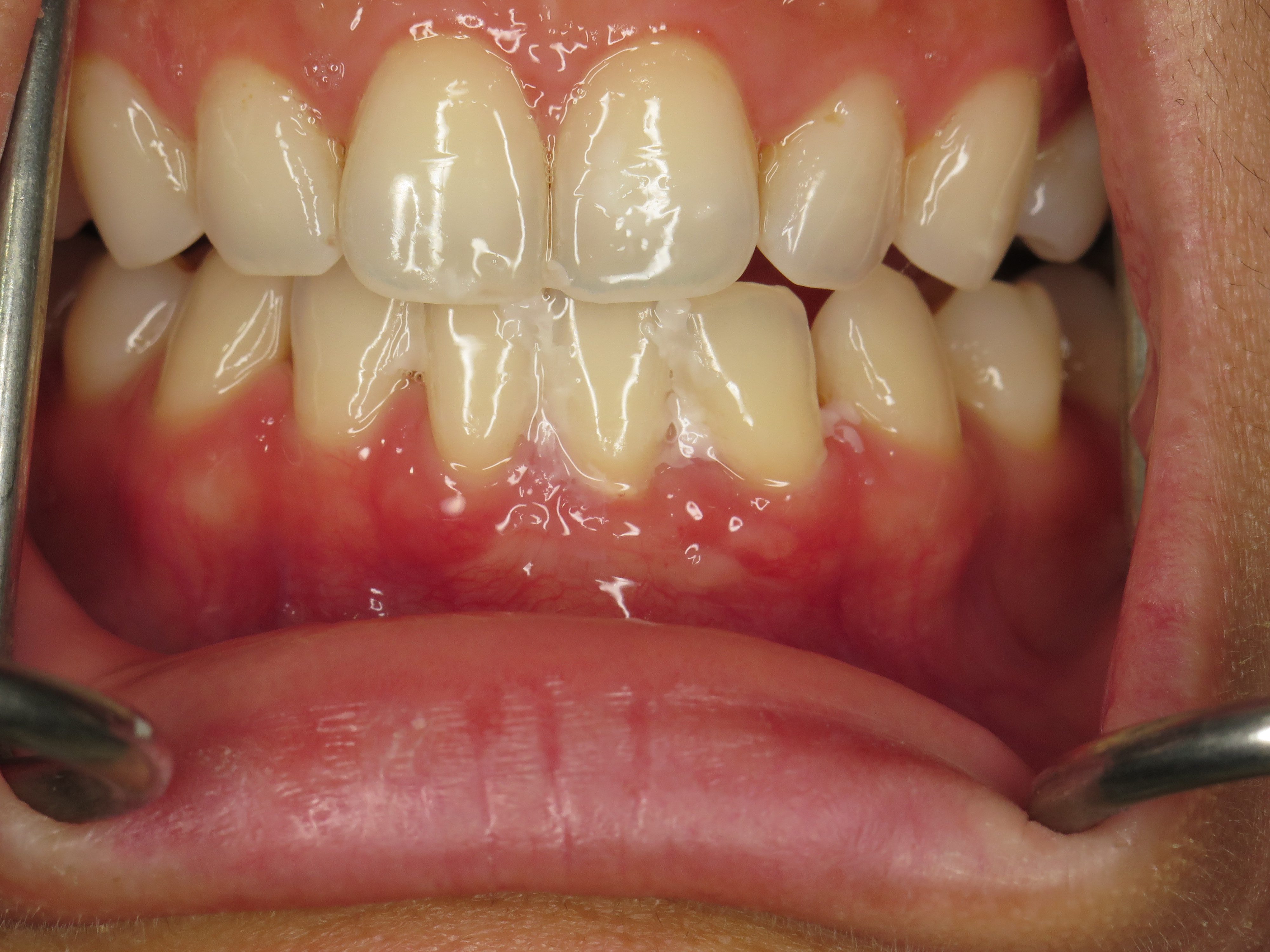 Connective Tissue Graft Used to Treat Gum Recession