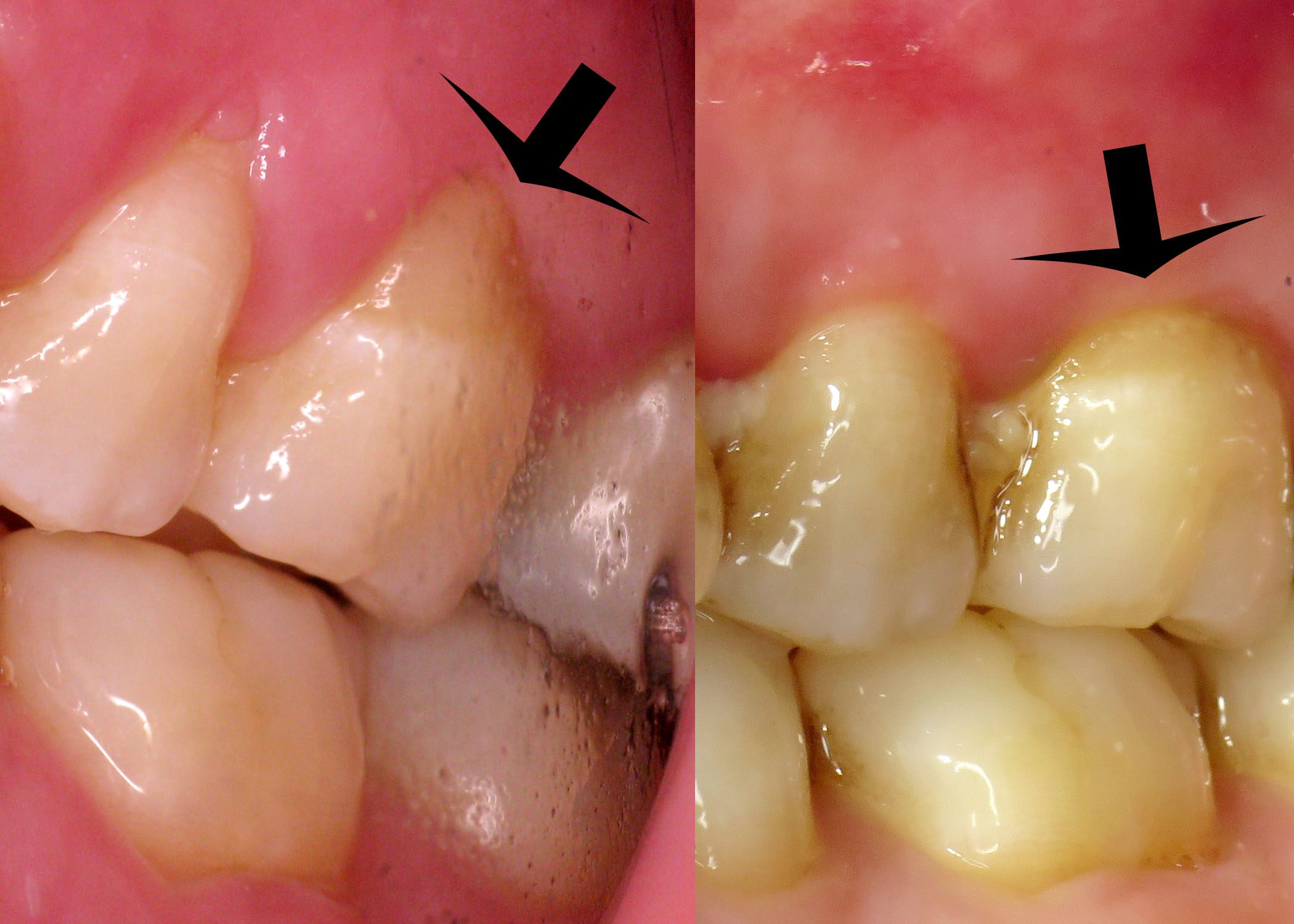 Treatment of Gingival Recession