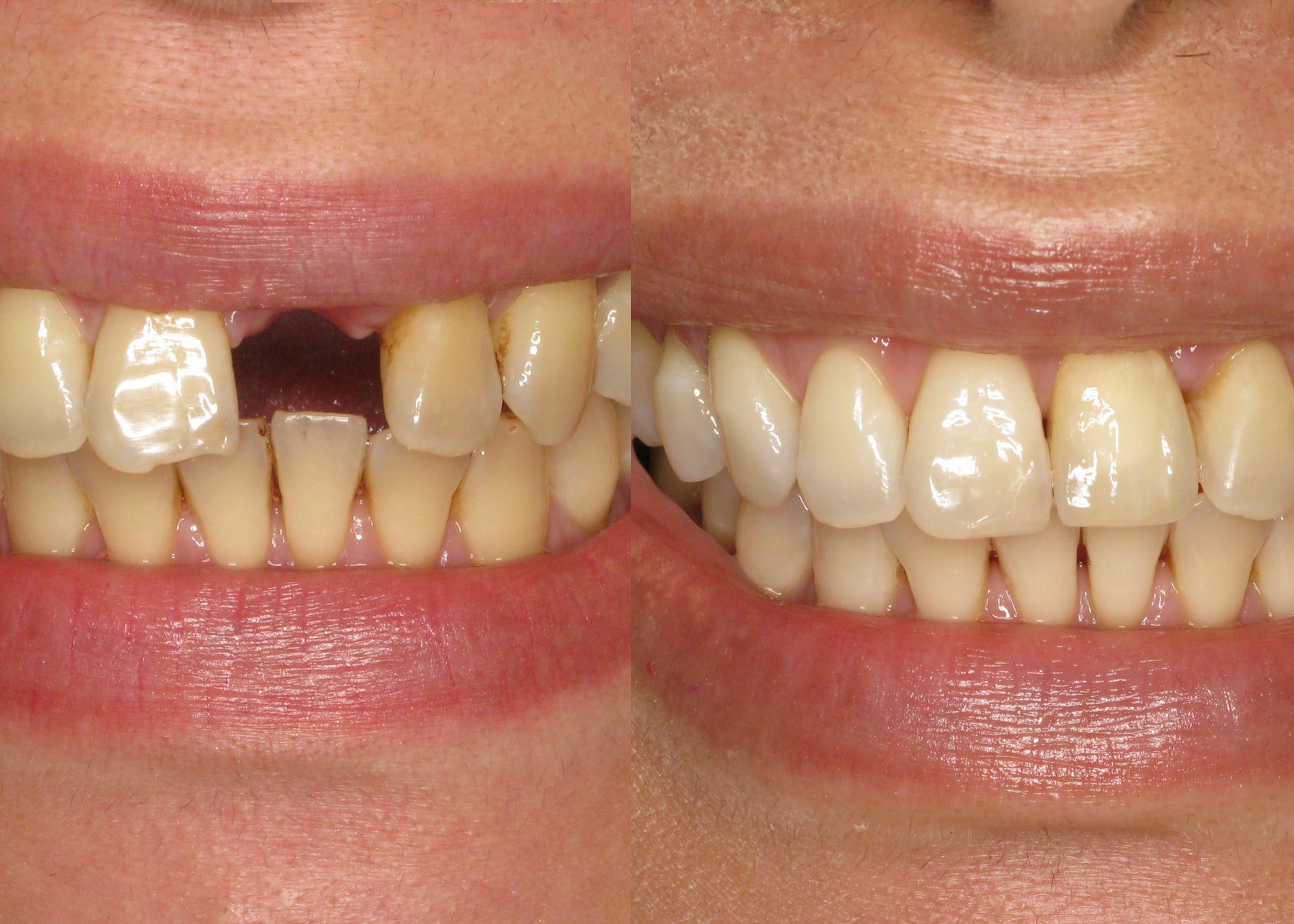 Front Tooth Replaced with Dental Implant