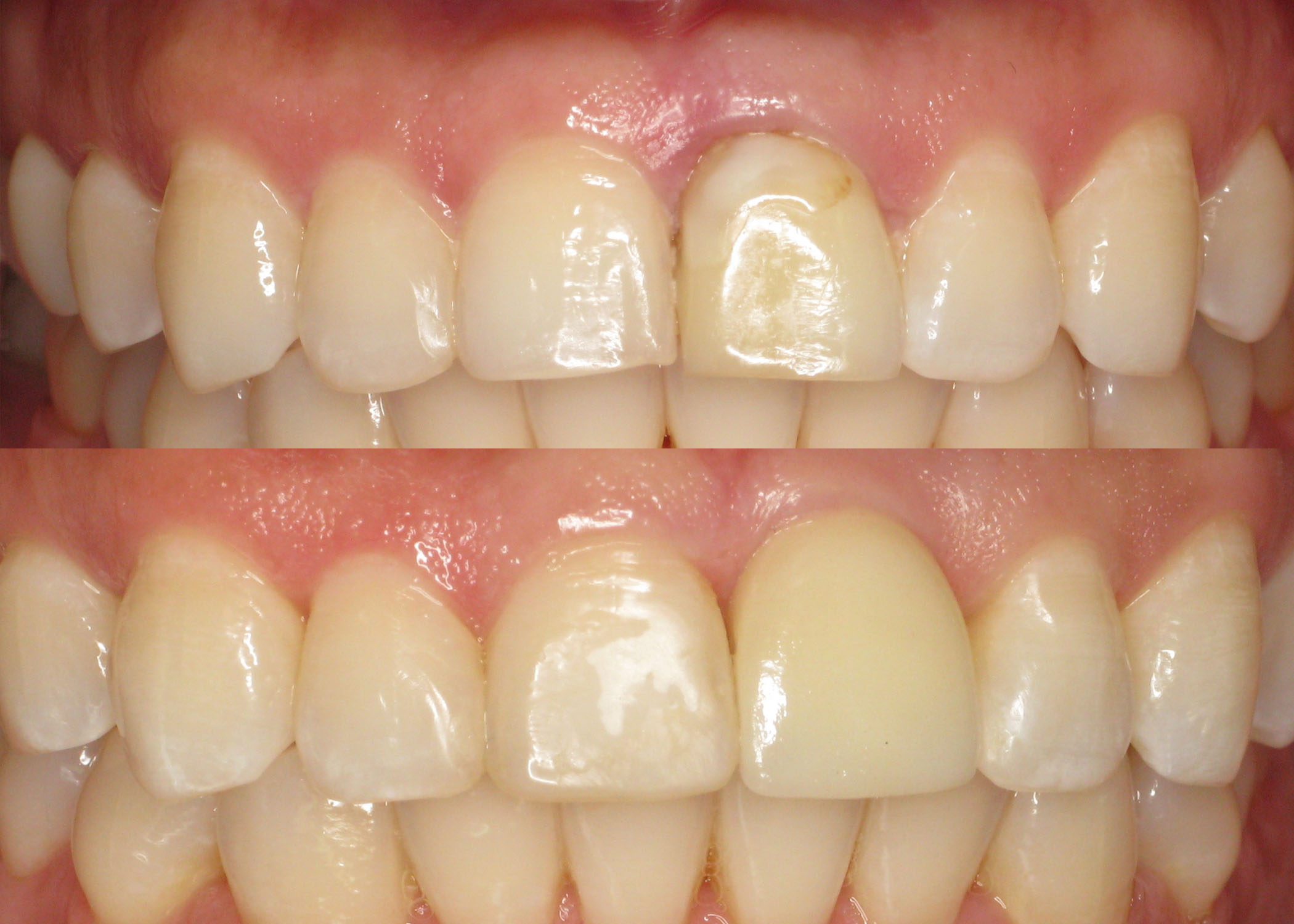 Zirconia Implant Used to Replace Tooth with Deep Cavity