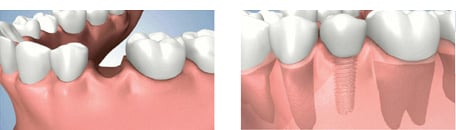 Placement of Dental Implant in Preserved Bone