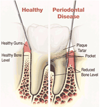 Causes of Periodontal Disease
