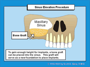 Sinus Elevation Procedure