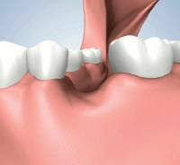 Socket Preservation Before Bone Graft