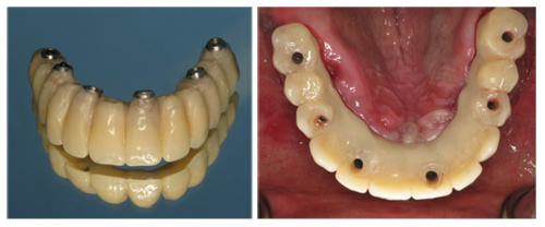 Benefits of Fixed Dental Implants