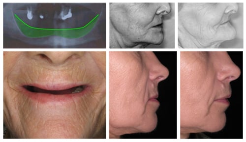 Accelerated Bone Loss Induced by Dentures
