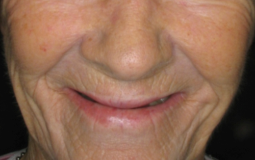 Sunken Face Caused by Dentures