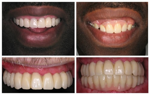Poor Aesthetics Caused by Dentures