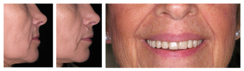 Dentures Can Cause Your Lips to Appear Enlarged or Bulky