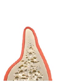 Inadequate Bone Width for Dental Implants