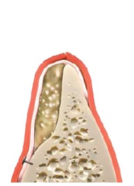 Successful Implant Bone Width