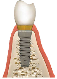 Adequate Bone Width for Implant Placement