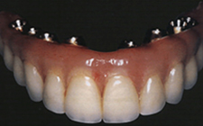 Implant Teeth, which do not impair speech