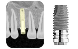 Why Dental Implants?