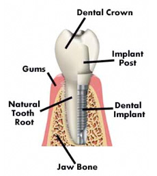 Information about Dental Implants