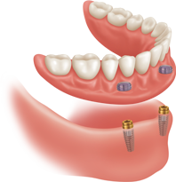Mini Dental Implants Locator