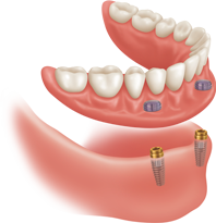 Mini Dental Implants Locator