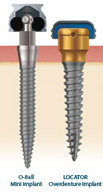 Mini Dental Implants NYC