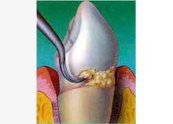 Treatment of Gum Disease