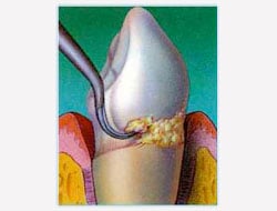Gum Disease Scaling and Root Planing