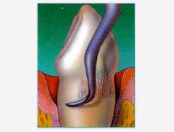 Gum Disease Flap Therapy
