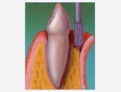 Gum Disease Treatment NYC
