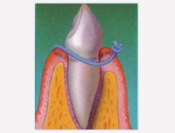 Guided Tissue Regeneration