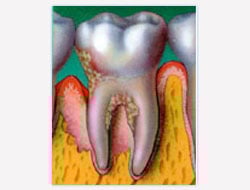 Gum Disease Recovery New York City