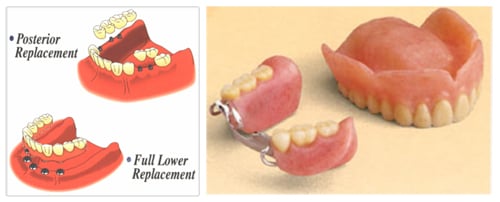 Dental Implants for Posterior Teeth Replacement