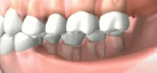 Consequences of Missing Several Teeth