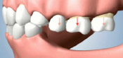 Shrinking of Jawbone after Tooth Loss