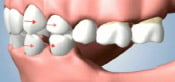 Teeth drifting towards open space