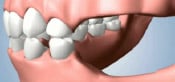 Jawbone Preservation Techniques