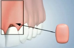 Gum Tissue Augmentation