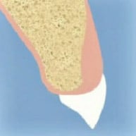 Gum Tissue Augmentation NYC