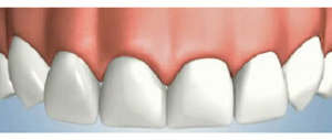 Dental Implant and Gum Restoration