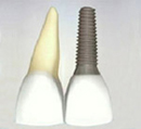 Natural Looking Dental Implants NYC