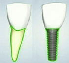 Dental Implant Root