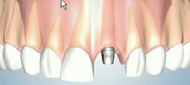Dental Implant Custom Restoration NYC
