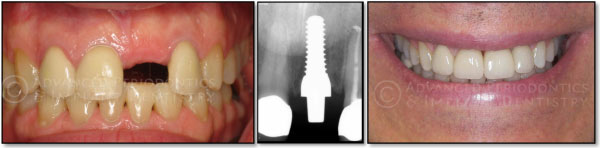 Tooth Replacement with Zirconia Implants
