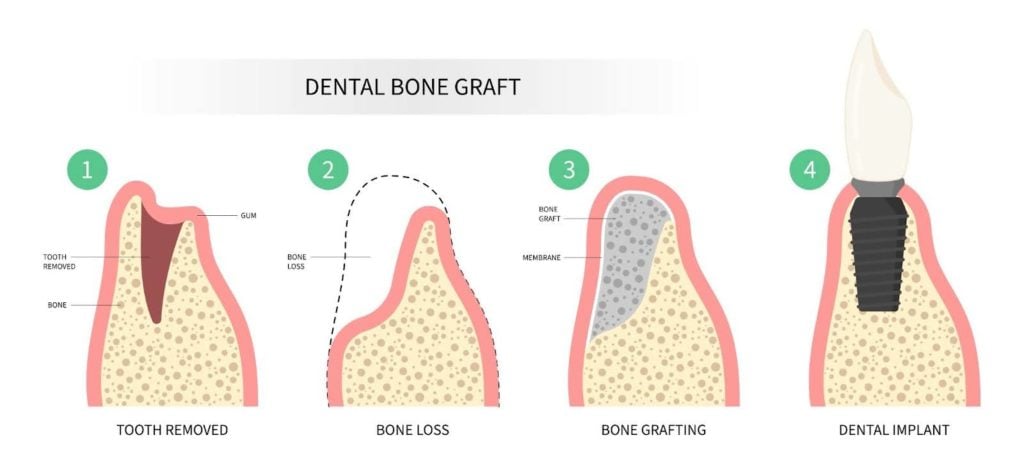 Dental bone graft