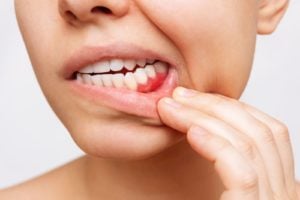 Can You Get Dental Implants with Gum Disease?